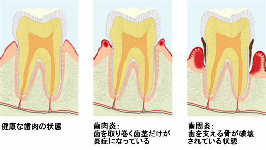 歯周病3