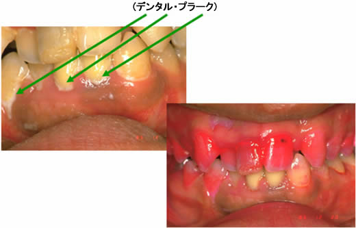 歯周病7